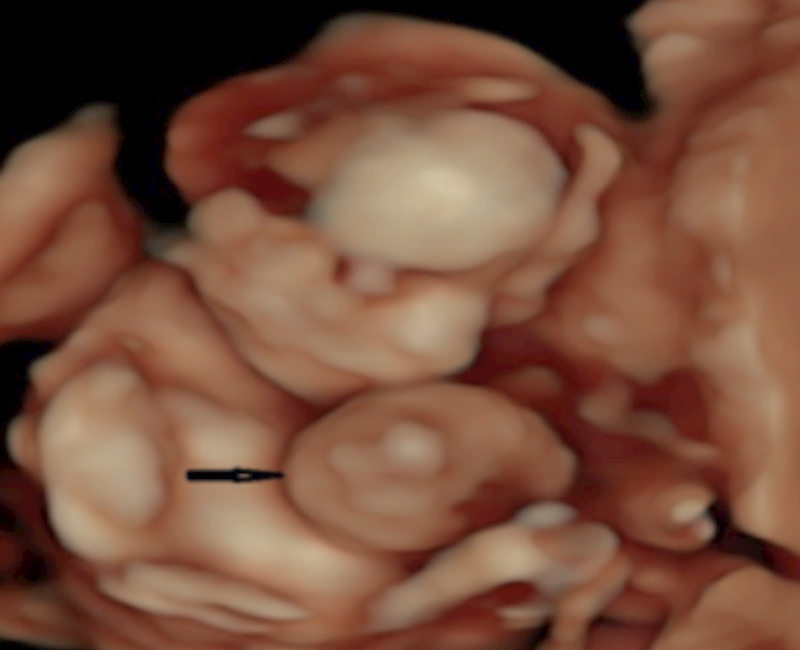 Omphalocele and gastroschisis: An analysis of prenatal diagnosis and neonatal outcomes